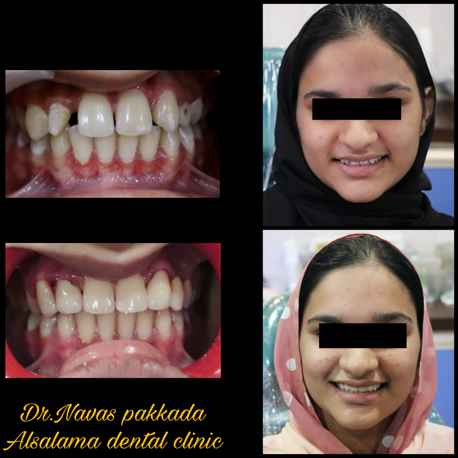 Smile designing